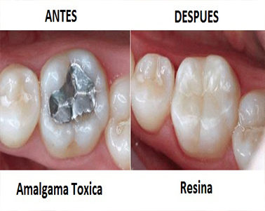 cambio amalgama coslada